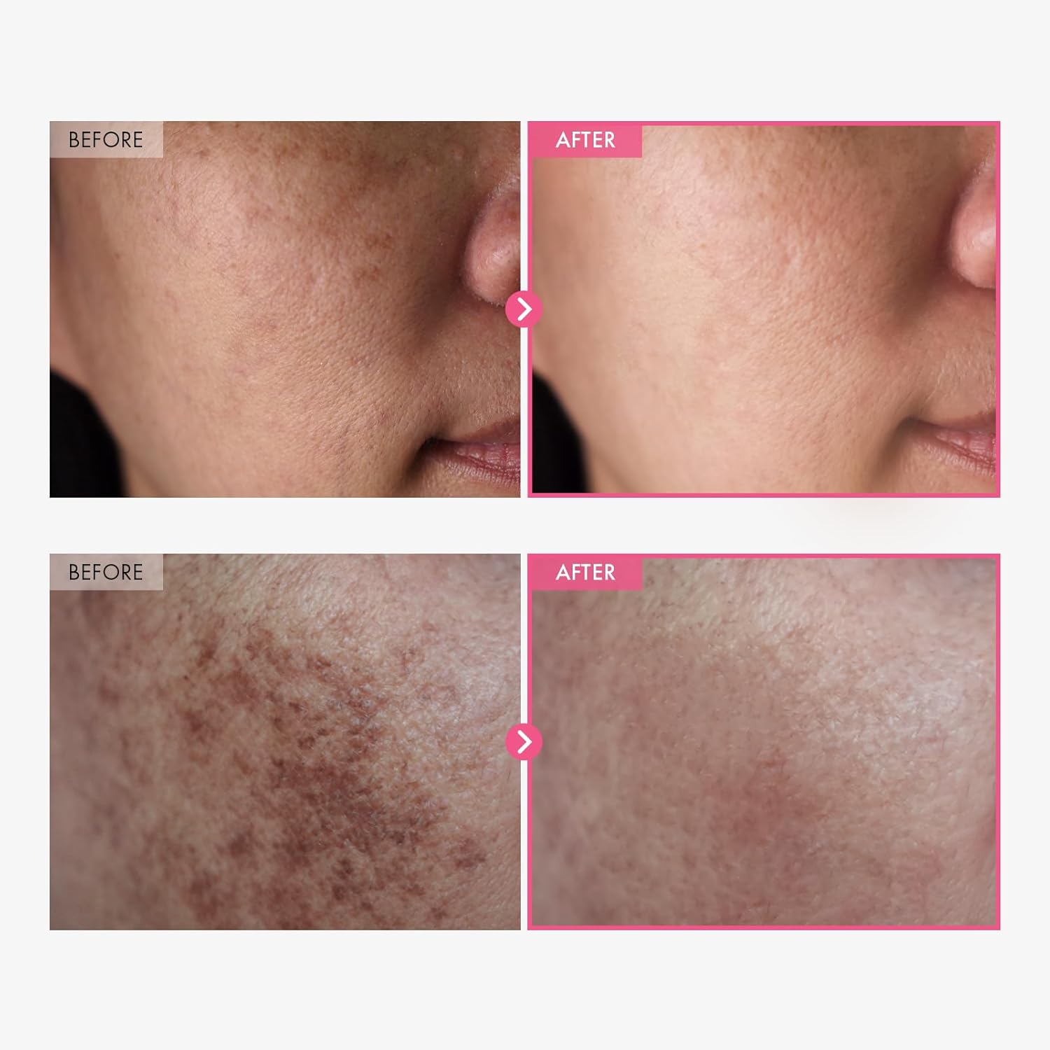 Arbutin Brightening Cream: Unify Your Complexion, Reveal Your Glow