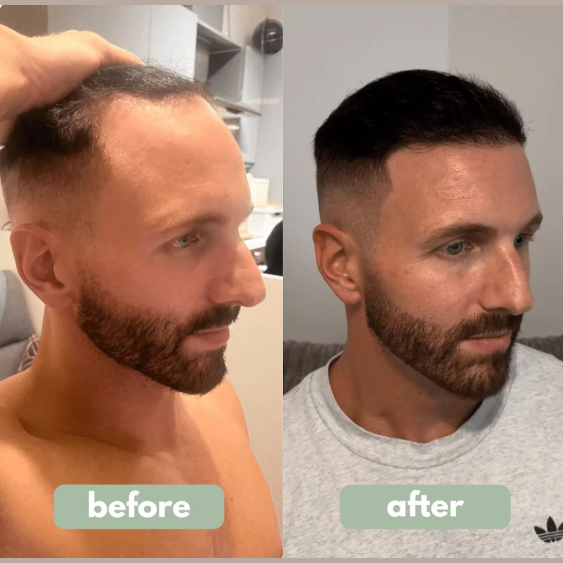 👑 Reverse™ Hair Growth Serum: Reclaim Your Hair, Reclaim Your Confidence.