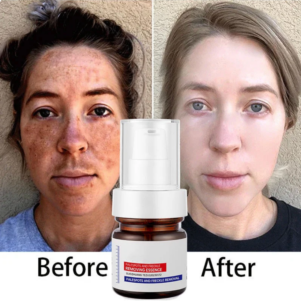 Vitamin C Whitening Freckles ESSENCE: Fade Dark Spots, Melasma, and Achieve Your Flawless.