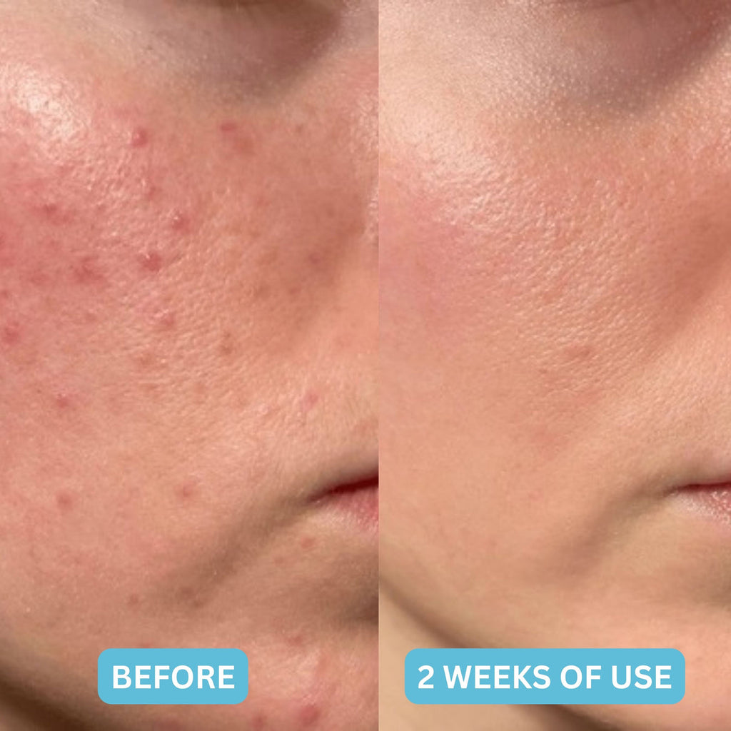 HydroClear™ Medical-Grade Hydrocolloid Roll